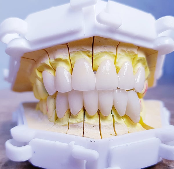 boc-rang-su-nha-khoa-dong-dong