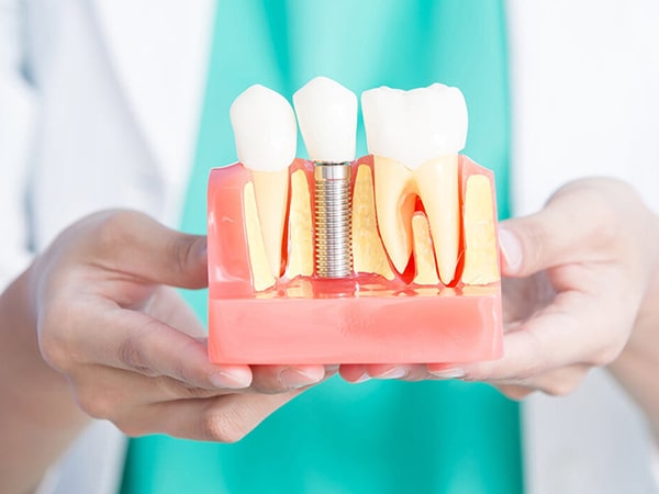 trong-rang-implant-nha-khoa-dong-dong
