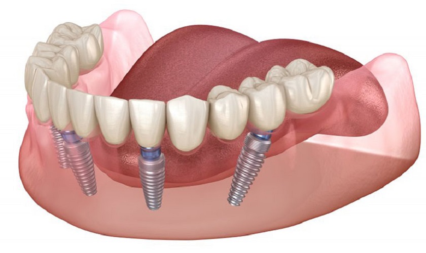 trong rang implant nguyen ham